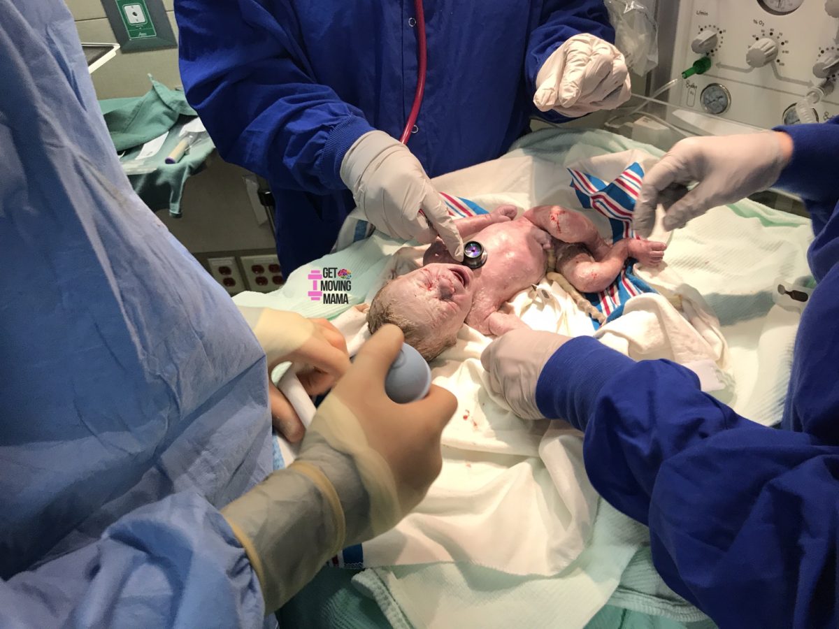 A picture of a newborn being checked by doctors from the NICU right after high risk birth.