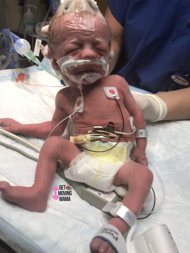 A picture of a preemie newborn right after a high risk birth.